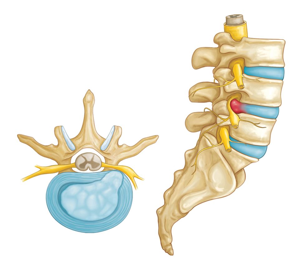 Disc Prolapse: A Comprehensive Guide for Patients by Dr. Mayur Rabhadiya 1 Dr. Mayur Rabhadiya